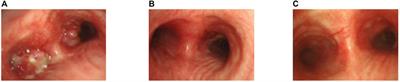First case report of a novel KIF13A-ALK fusion in a lung adenocarcinoma patient and response to alectinib with a 4-year follow-up